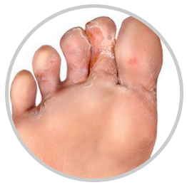 Pleseň medzi palcami na nohách • Ako sa jej účinne zbaviť?