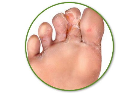 Pleseň medzi palcami na nohách • Ako sa jej účinne zbaviť?